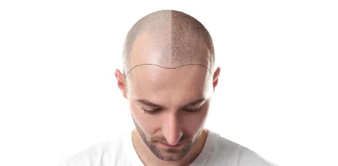 Hair Transplantation in Udaipur