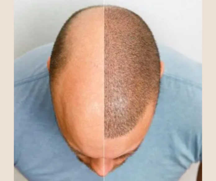 Hair Transplant in Udaipur