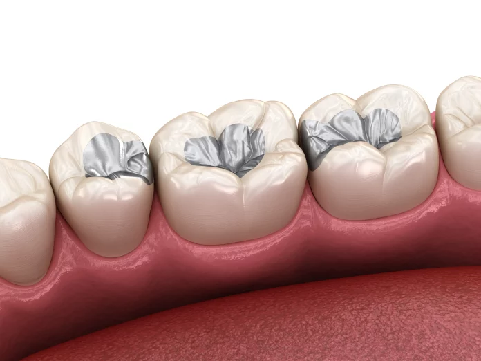 Dental implant surgery