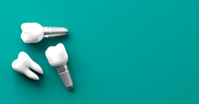 Dental Implant center in Udaipur